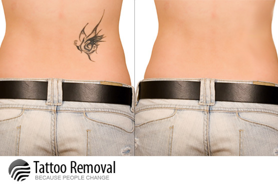... tattoo removal sessions (up to 7x4) from Pulse Light Clinic, central