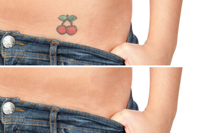 1 or 3 laser tattoo removal sessions ealing 1 or 3 laser tattoo removal sessions ealing