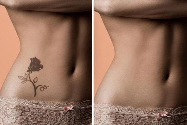 100+ [ 49 Best Laser Tattoo Removal ] | Tattoo Removal ...