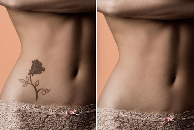 3 sessions tattoo removal 3 area sizes 3 sessions tattoo removal 3 area sizes